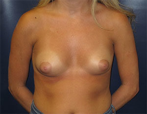 Breast Augmentation Case 405 Before Photo Breast Augmentation