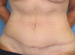 Tummy Tuck