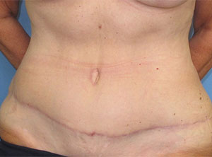 Breast Tummy Tuck Before and After