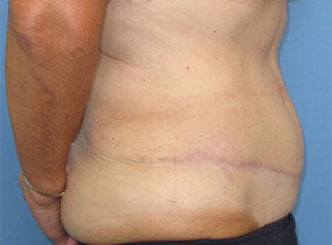 Tummy Tuck