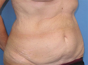 Tummy Tuck Before and After Gallery