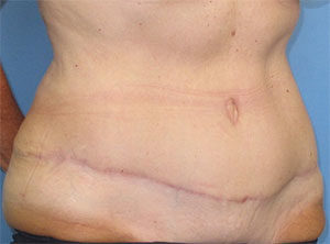 Tummy Tuck Before and After Gallery