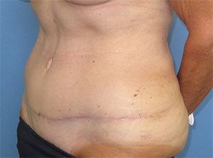 Tummy Tuck Before and After Gallery