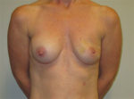 Breast Reconstruction