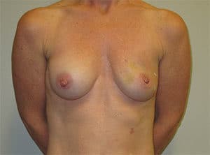 Breast Reconstruction Before and After Gallery