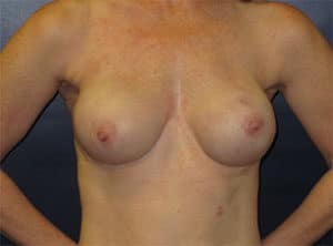 Breast Reconstruction Before and After Gallery