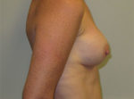 Breast Reconstruction