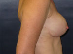 Breast Reconstruction