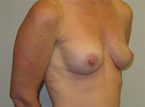 Breast Reconstruction Before and After Gallery