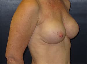 Breast Reconstruction Before and After Gallery