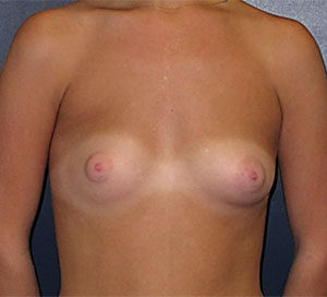 Breast Augmentation