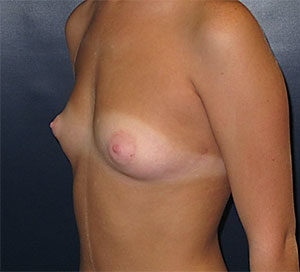 Breast Augmentation