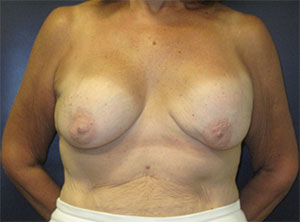 Breast Revision Before and After