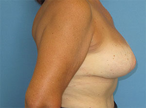 Breast Implant Exchange Before and After Gallery