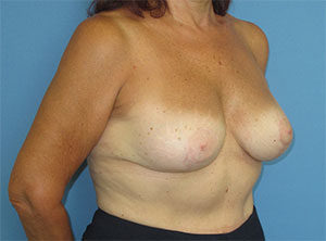 Breast Implant Exchange Before and After Gallery