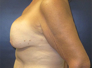 Breast Implant Exchange Before and After Gallery