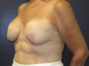 Breast Implant Exchange Before and After Gallery