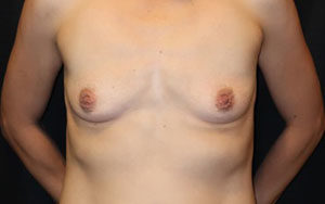Breast Augmentation Case 631 Before Photo Breast Augmentation
