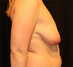 Breast Lift Before and After Gallery