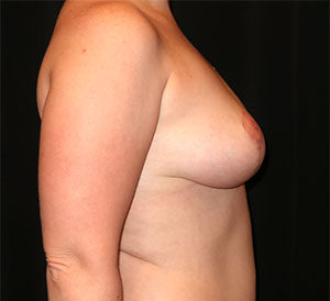 Breast Lift Before and After Gallery