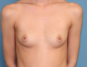 Breast Reconstruction Before and After Gallery Case 598 Before Photo Breast Reconstruction Before and After Gallery