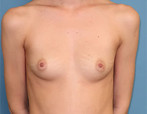 Breast Reconstruction