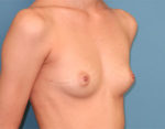 Breast Reconstruction