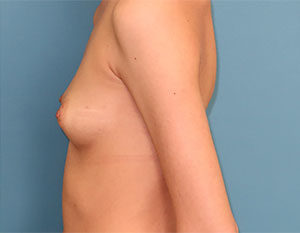 Breast Reconstruction Before and After Gallery Case 598 Before Photo Breast Reconstruction Before and After Gallery
