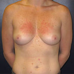 Breast Reconstruction