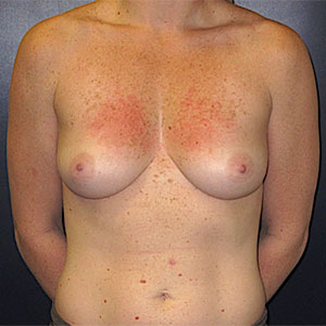 Breast Reconstruction Before and After