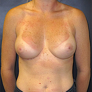 Breast Reconstruction Case 587 After Photo Breast Reconstruction