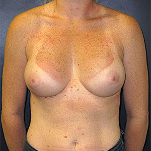 Breast Reconstruction