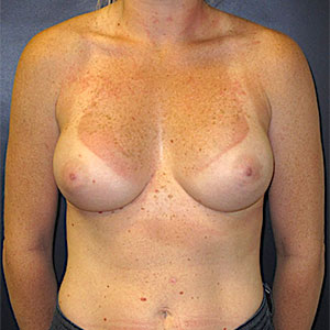 Breast Reconstruction Before and After
