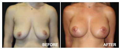 Implant With Lift