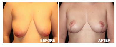 Breast Procedures