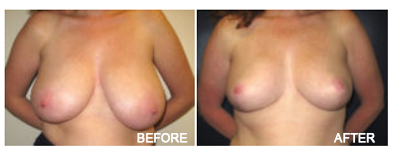 Breast Reduction