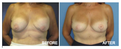 Breast Revision
