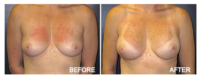 Breast Reconstruction