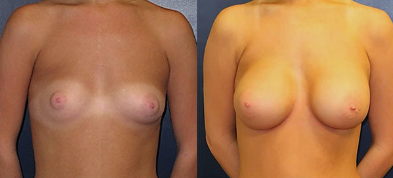 Breast Augmentation Before and After