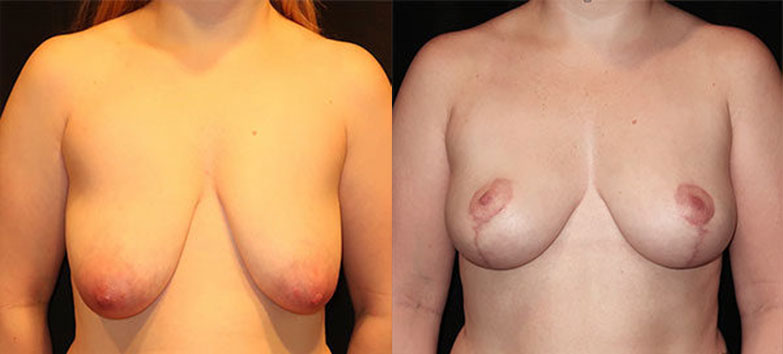 Breast Augmentation Before and After Charleston