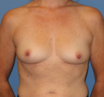 Breast Reconstruction