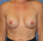 Breast Reconstruction