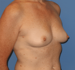 Breast Reconstruction Before and After Gallery