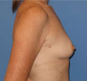 Breast Reconstruction Before and After Gallery