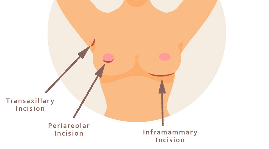 Breast augmentation incisions locations