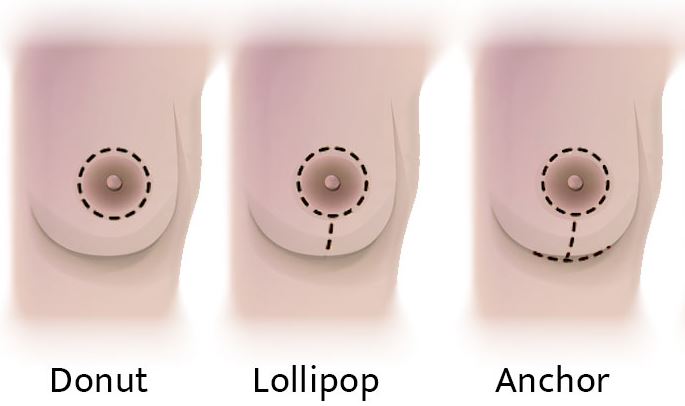 Breast lift incisions locations