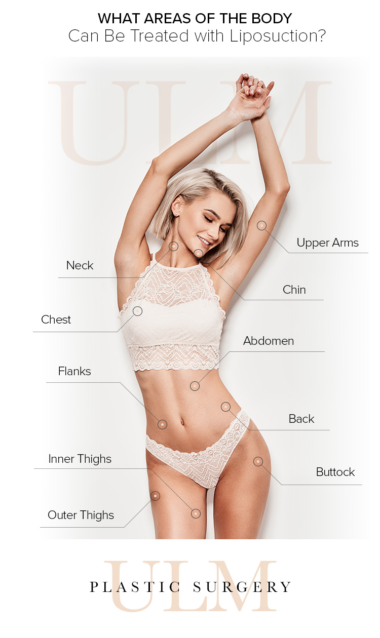 Areas of the Body That Can Be Treated with Liposuction