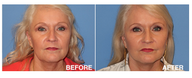 facelift
