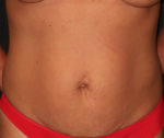 Tummy Tuck