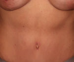 Tummy Tuck